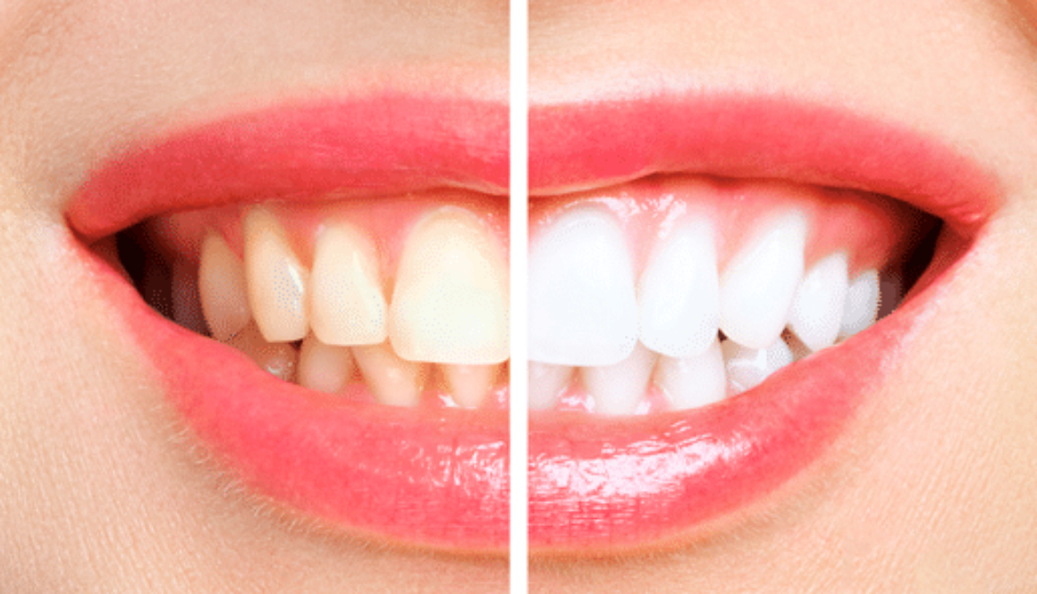 woman teeth comparison before and after whitening