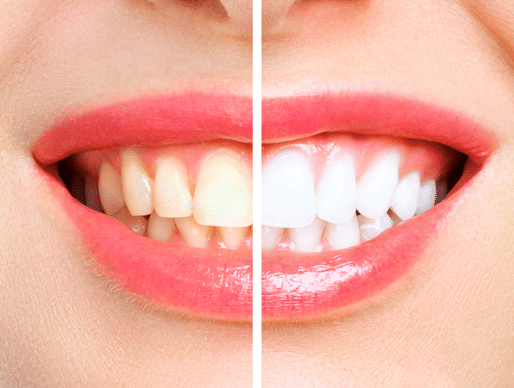 woman teeth comparison before and after whitening