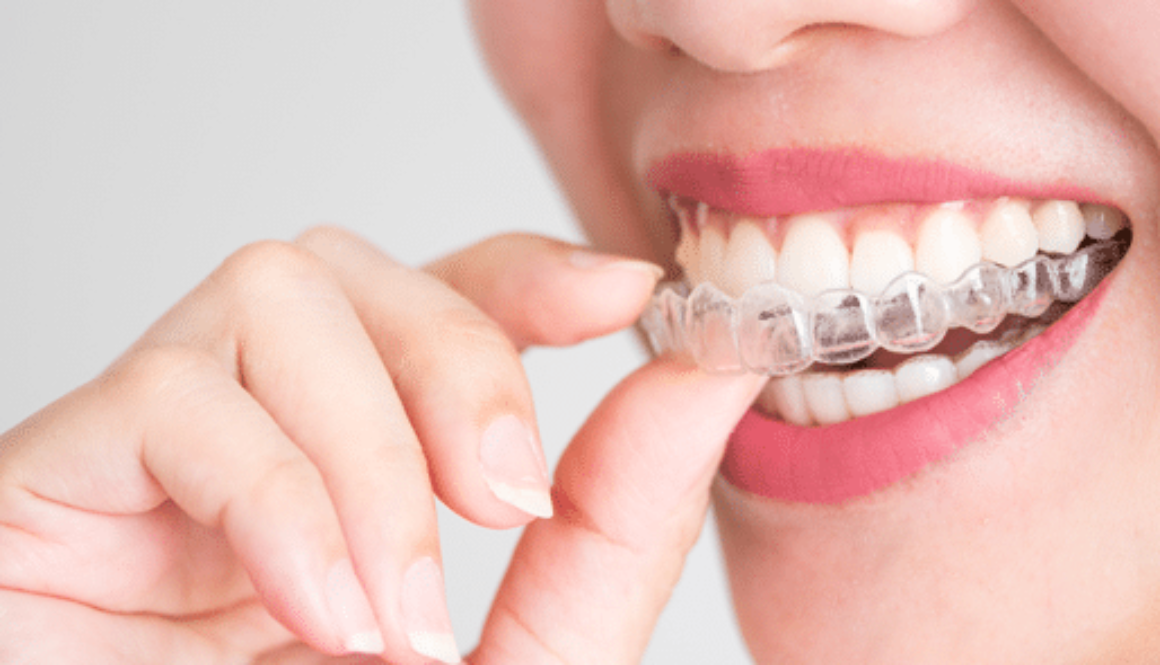 Close up of woman smiling and inserting invisalign appliance