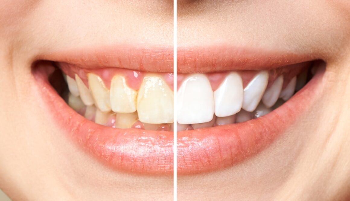 comparison between before and after teeth whitening
