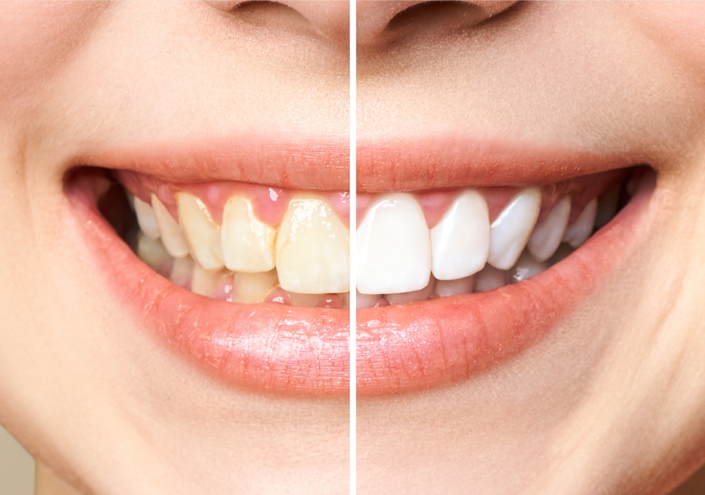 comparison between before and after teeth whitening