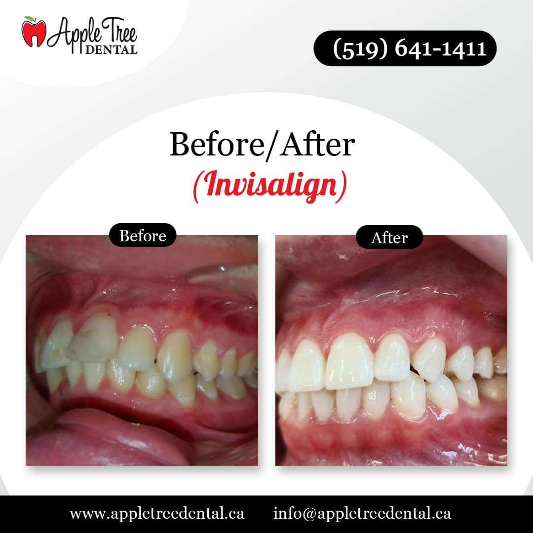 Before-After-ATD-Invisalign-1