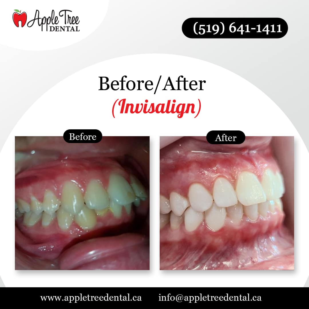 Before-After-ATD-Invisalign-2