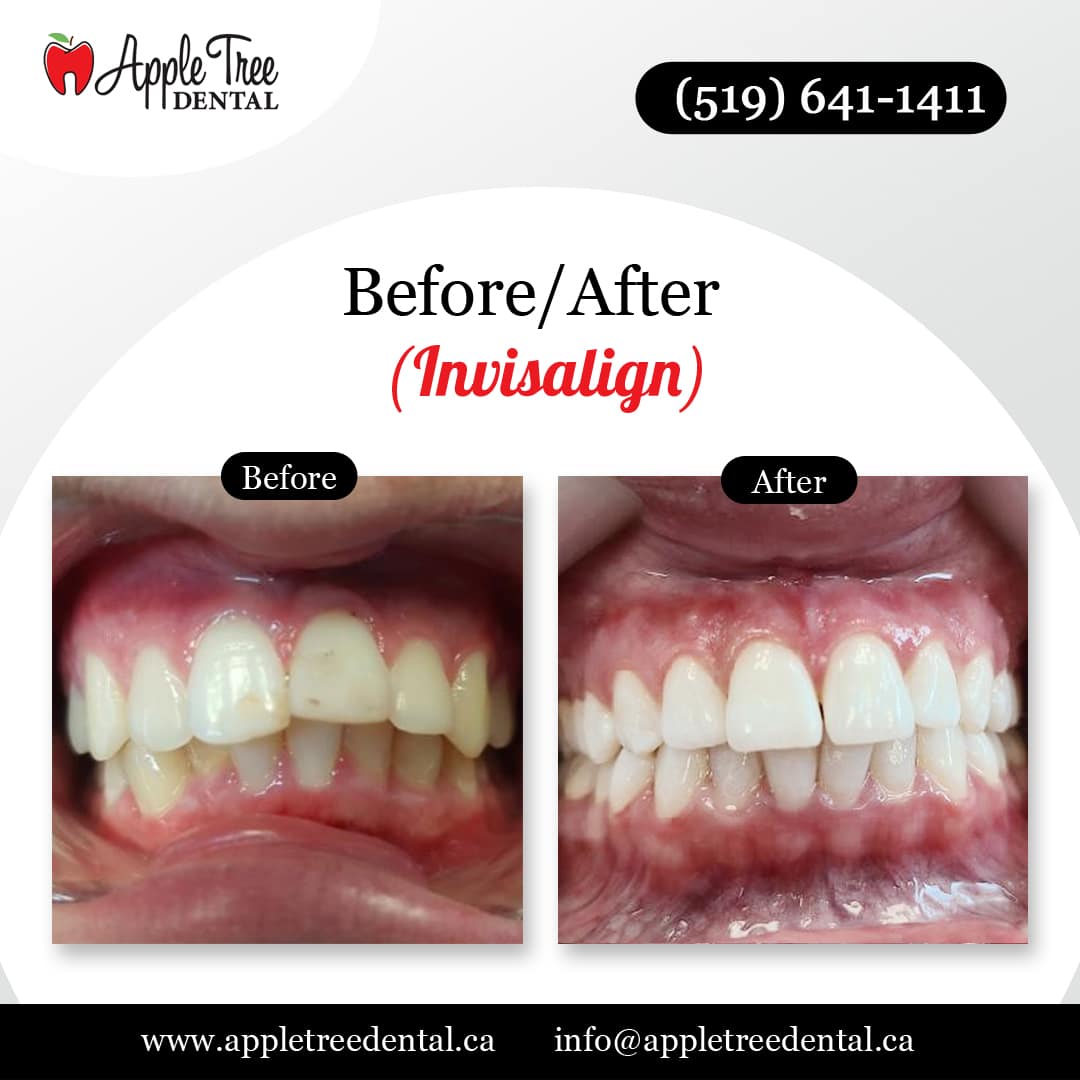 Before-After-ATD-Invisalign-3