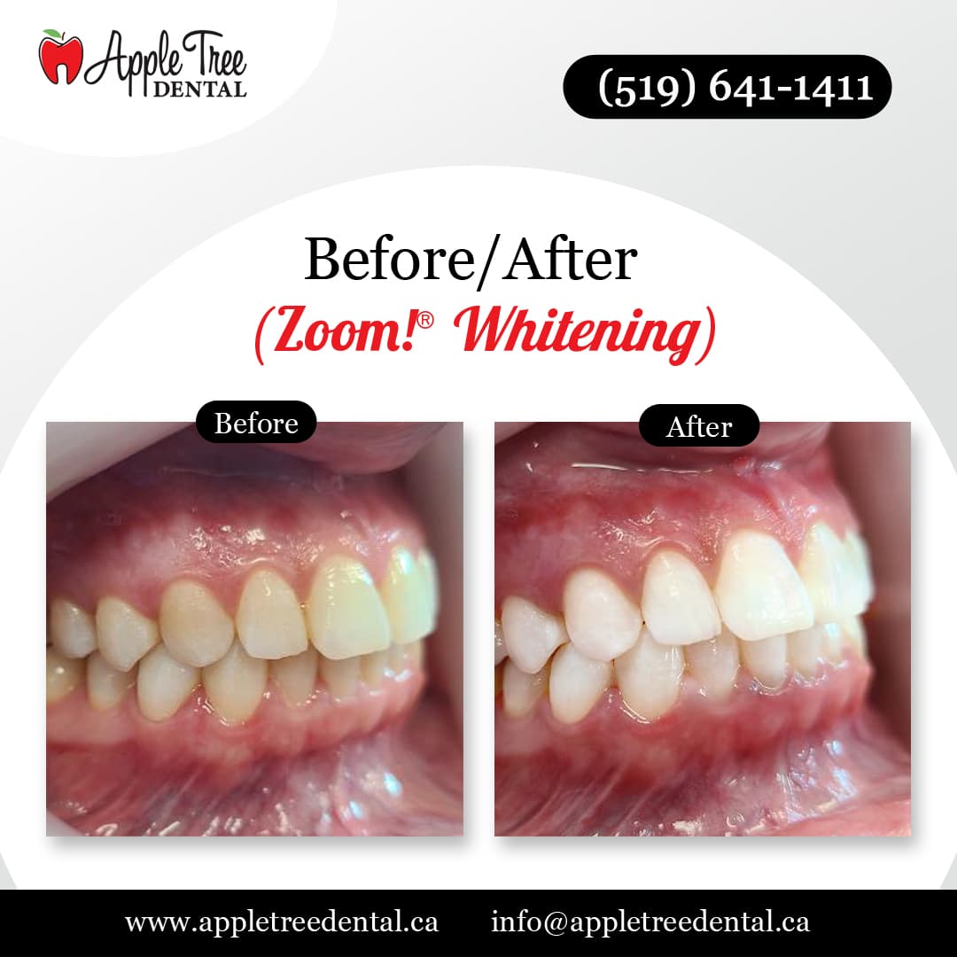 Before-After-ATD-ZoomWHitening-2