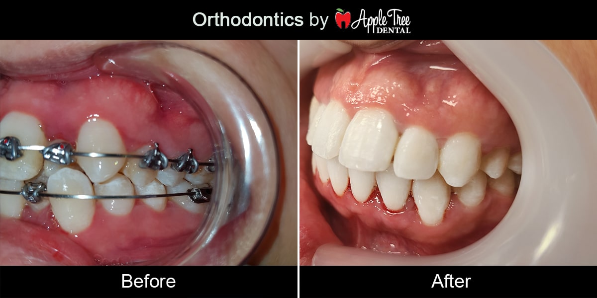 Orthodontics-3