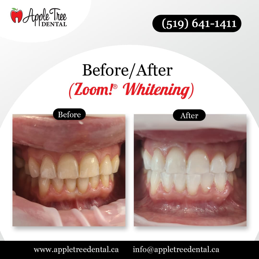 Before-After-ATD-ZoomWHitening-new