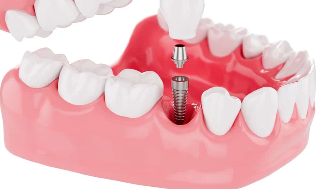 Reasons-Benefits-Of-Getting-A-Dental-Implant-Aple-Tree-Dental