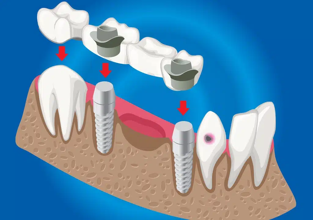 Bridges-An-Essential-Solution-for-Missing-Teeth-Apple-Dental-Tree