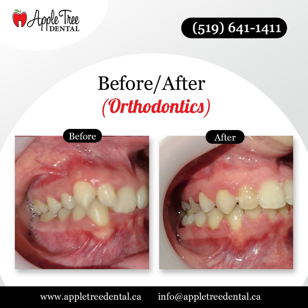 Ortho-Before-After-ATD-3