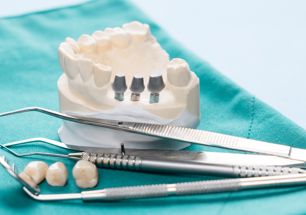 Navigating the Journey What to Expect Before, During, and After Dental Implant Surgery