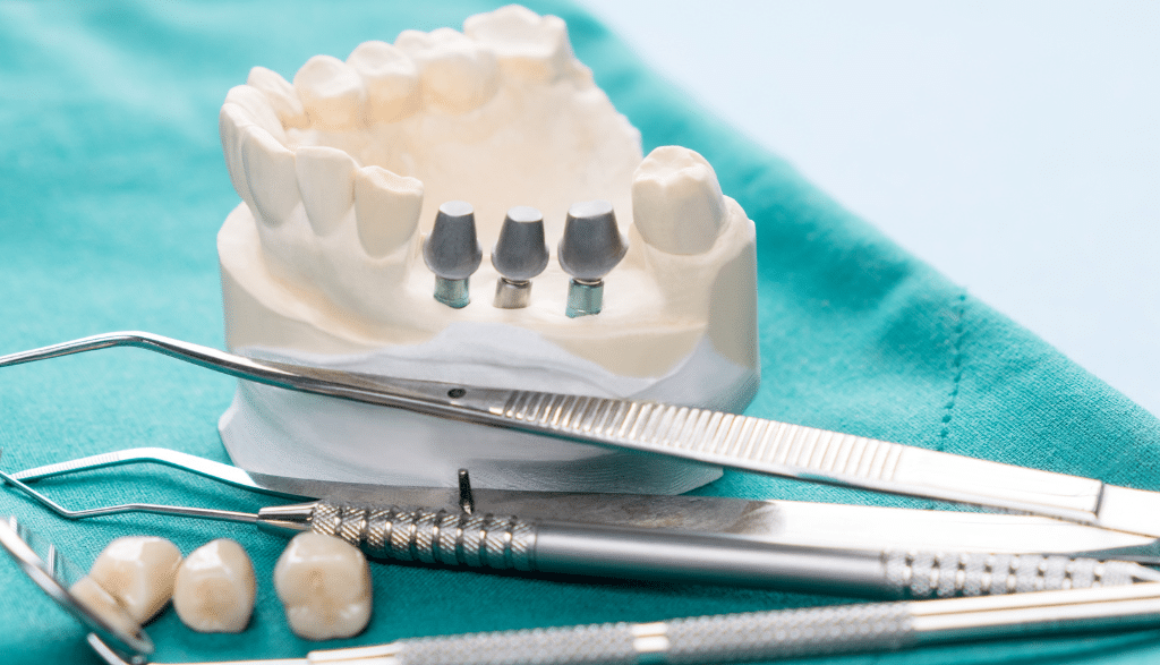 Navigating the Journey What to Expect Before, During, and After Dental Implant Surgery Ontario