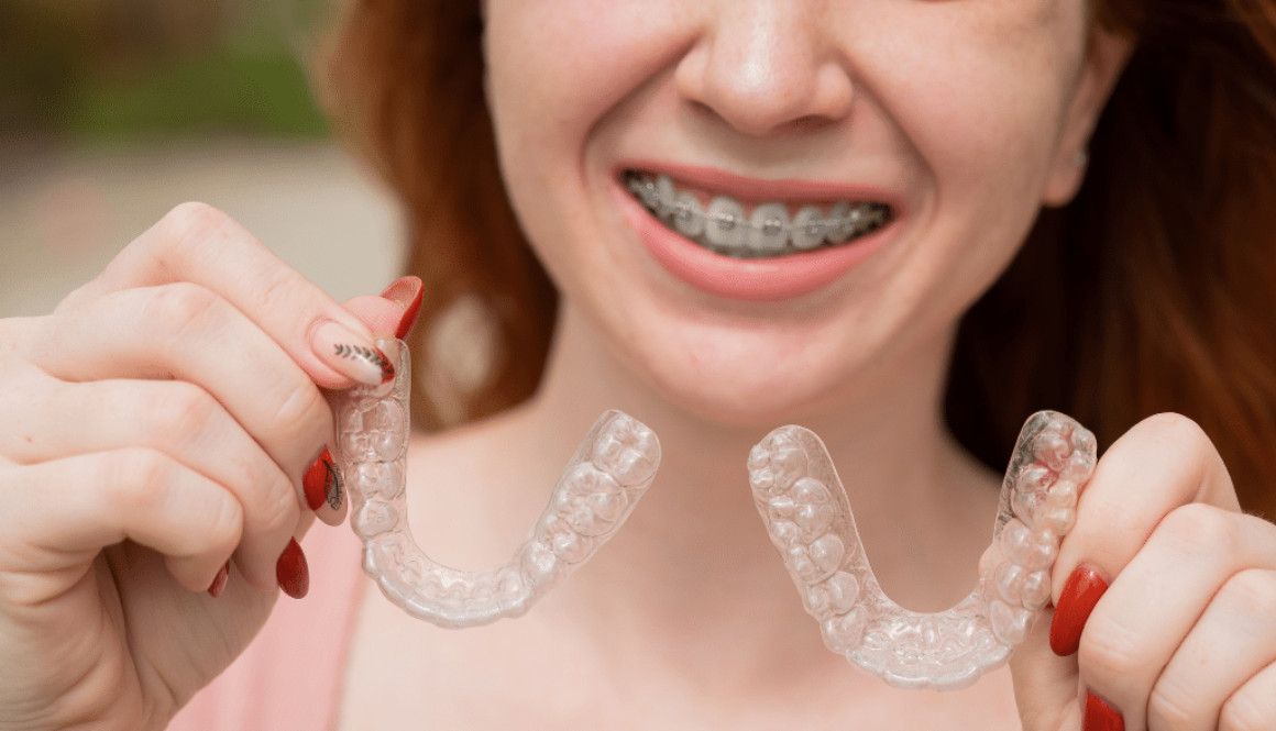 Top 5 Reasons to Choose Clear Aligners Over Traditional Braces in London, Ontario