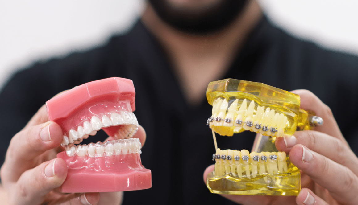 Unveiling Your Perfect Smile Clear Aligners vs. Braces in London, Ontario