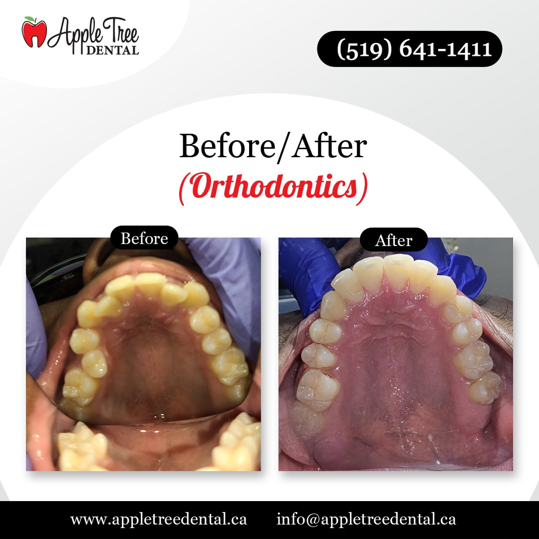 Before-After-ATD-Orthodontics