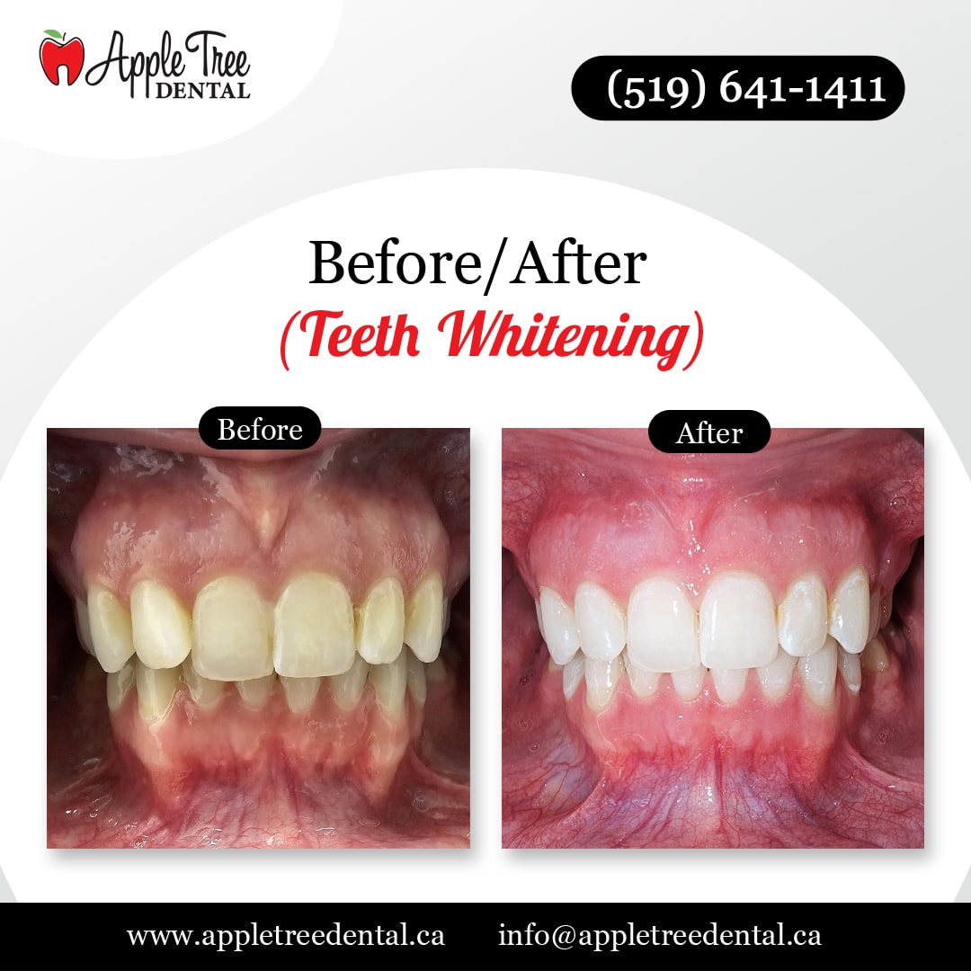 Before-After-ATD-TeethWHitening-2