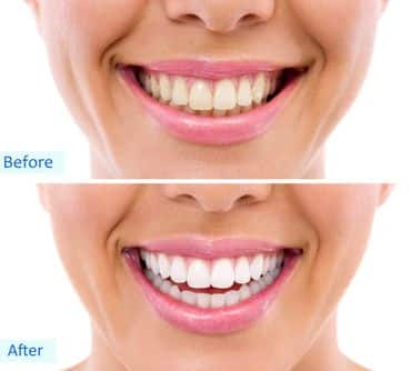 comparison between before and after teeth whitening