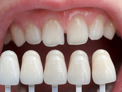 Comparing Veneers with the Kid's uneven teeths
