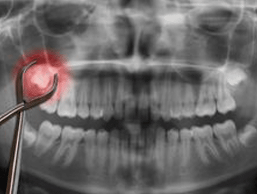 X-ray of the Tooth Extraction Process