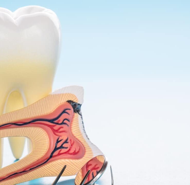 Representation of root canal with instrument