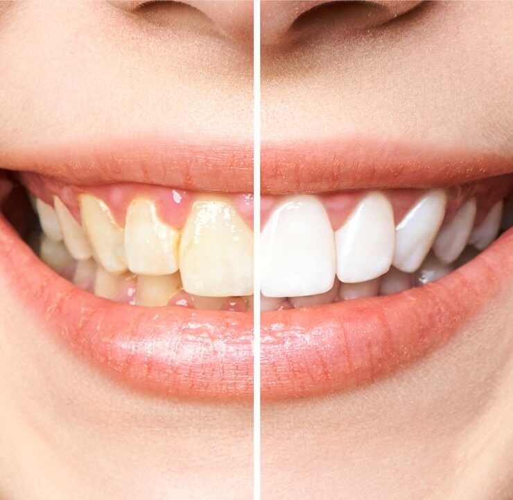 comparison between before and after teeth whitening