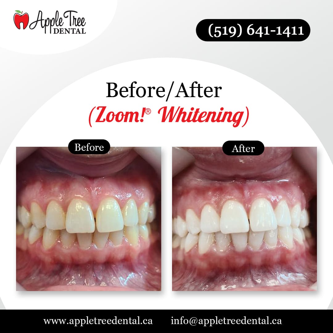 Before-After-ATD-ZoomWHitening-1