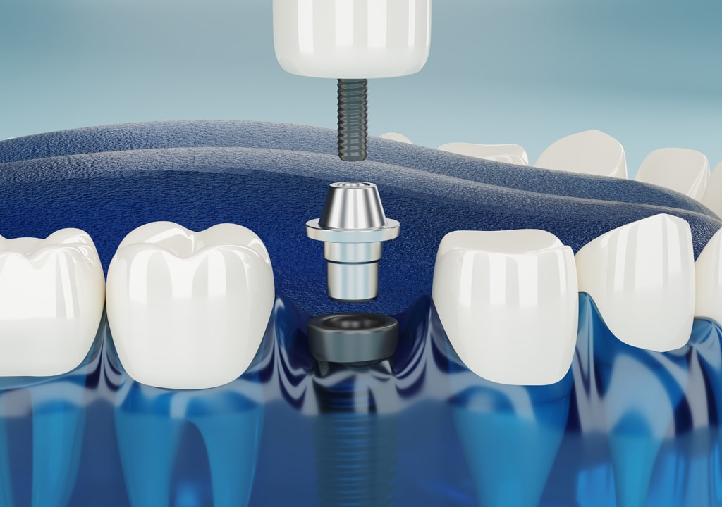 Best-Dental-Implants-Solution-Apple-Dental-Tree