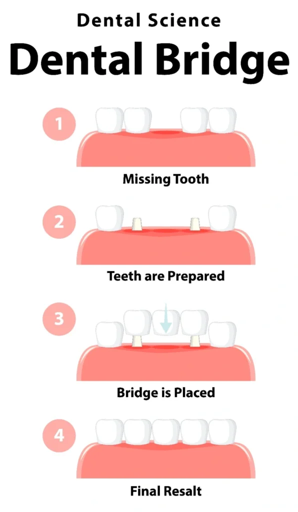 dental bridges and crowns
