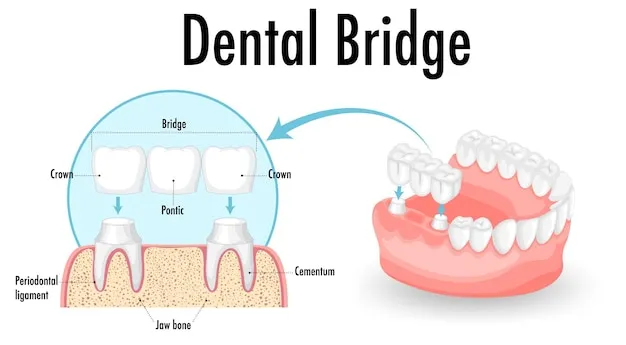 dental bridges and crowns