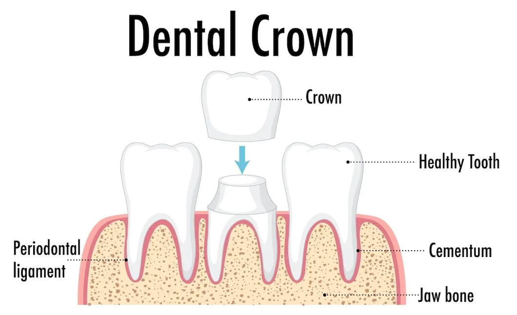 dental bridges and crowns