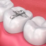 dental fillings