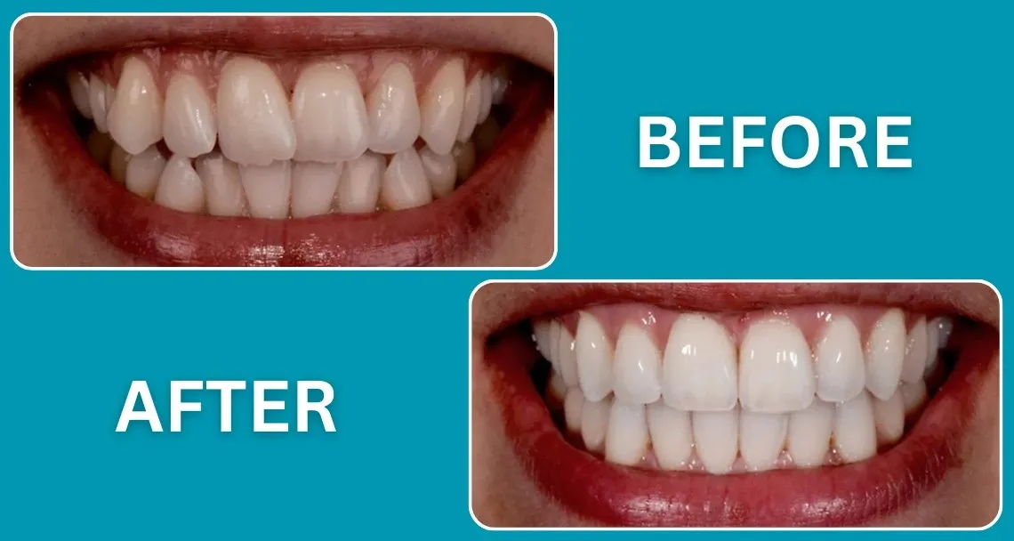 Braces Before and After