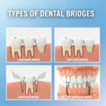 Types of Dental Bridges and Which One Is Right for You