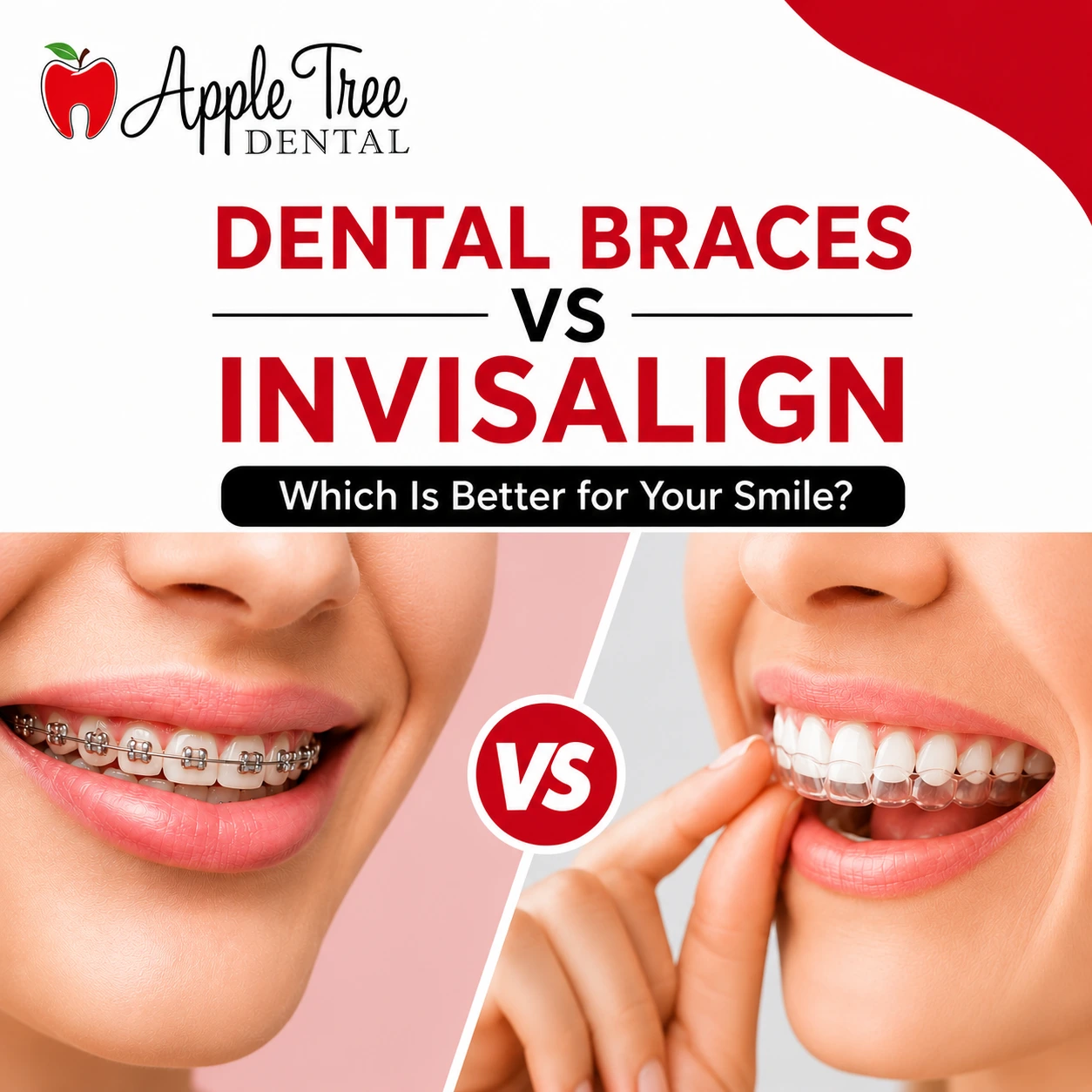 Dental Braces vs Invisalign