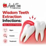 Wisdom Teeth Extraction