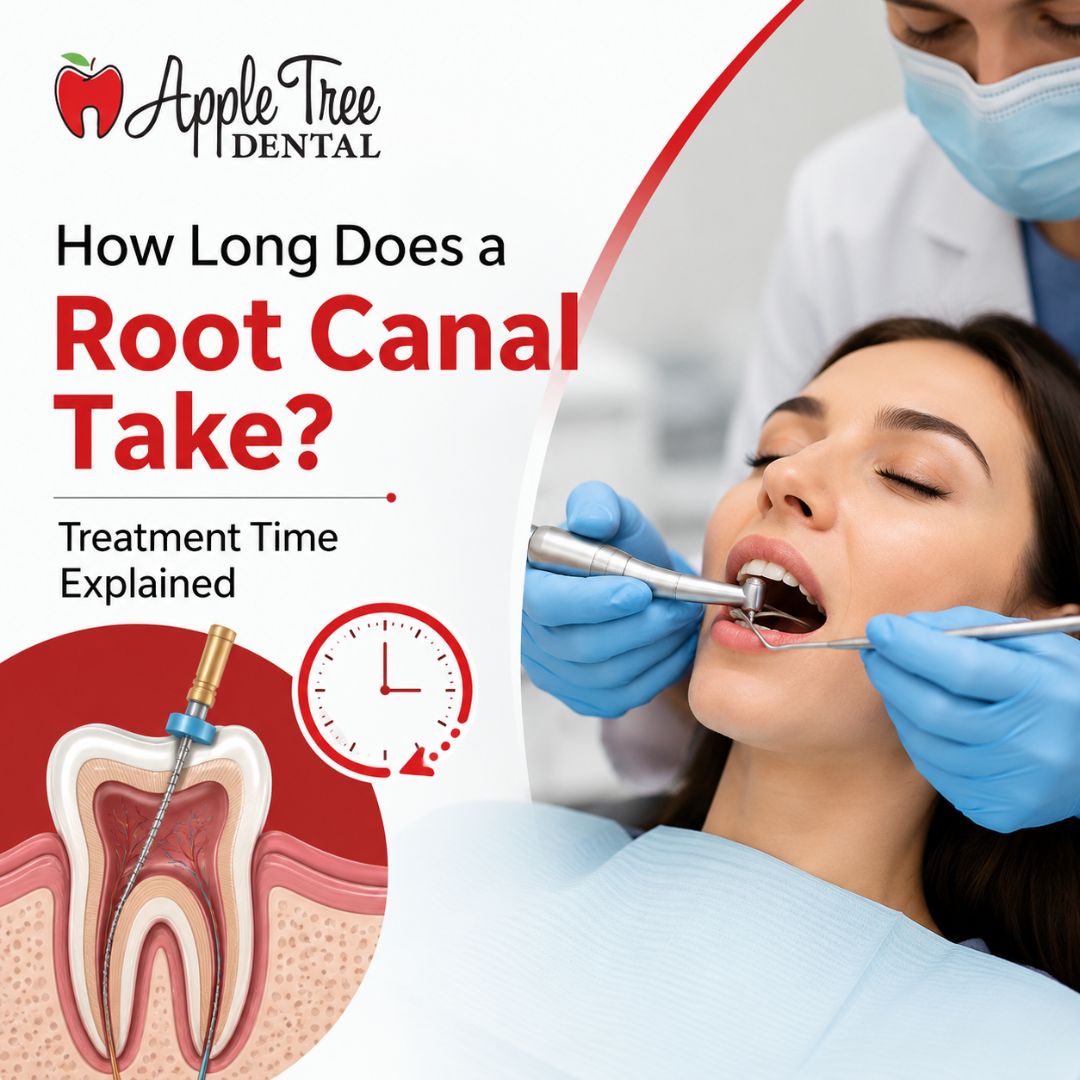 How Long Does a Root Canal Take