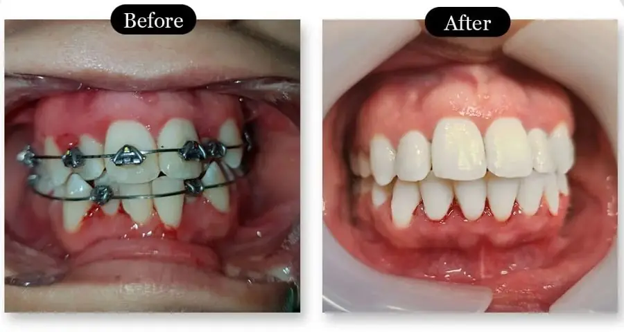 Fast Braces before and after: crowded front teeth straightened into an even smile