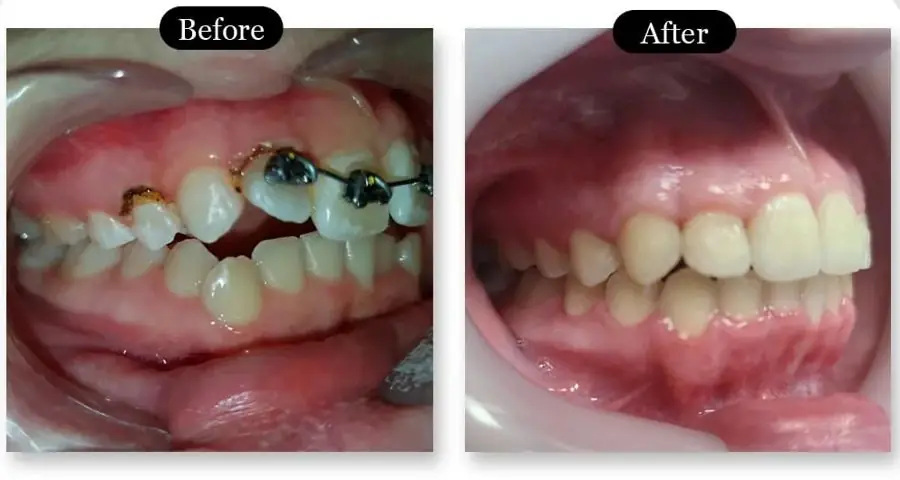 Fast Braces before and after: a gap closed and the bite levelled